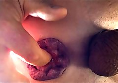 My mancunt extreme manpussy anal gape prolapse beach nudist