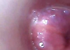 test tube cock endoscope POV urethral insertion ball rod